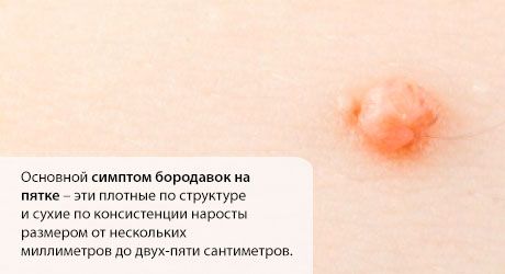 발꿈치에 사마귀 : 어떻게해야합니까?