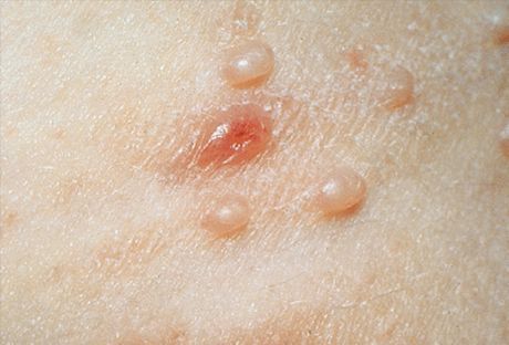 Molluscum contagiosum : 사진