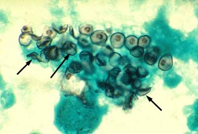 폐포자충증(Pneumocystis jiroveci)의 원인균